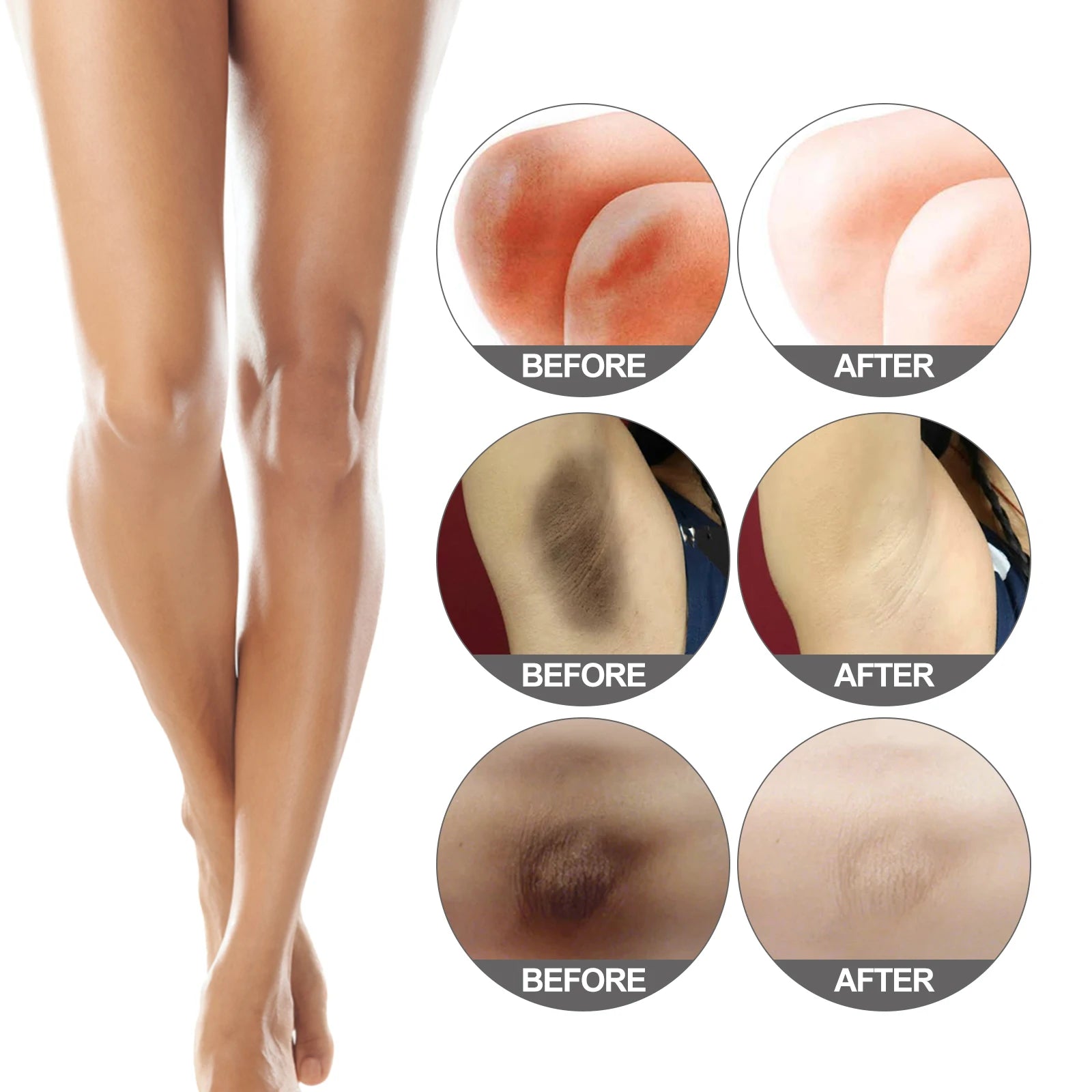 Miracle Bleach Cream Nicotinamide Brighten Private Parts Underarm Bleaching Armpit Elbow Knees Joint Removal Dark Spot Melanin